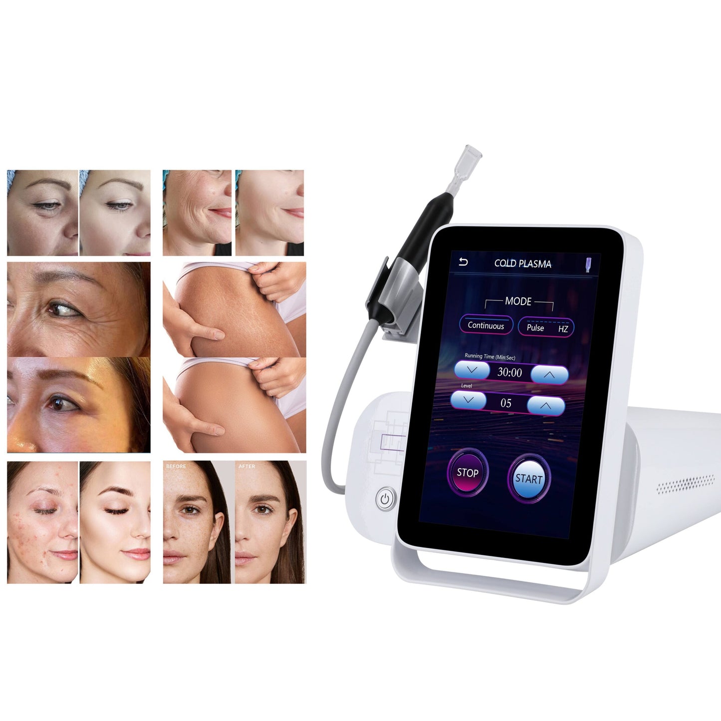 Cold Plasma Machine -Advanced Non-Invasive Skin Regeneration & Sterilization image 2