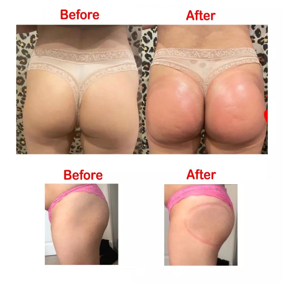 Butt Lifting Vacuum Therapy Xxxl Cups/Vacuum Suction Cup Therapy/Breast Enhancement Buttocks Enlargement Machine